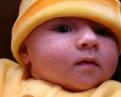 Детское акне заболевание кожи: от грудничка до подростка